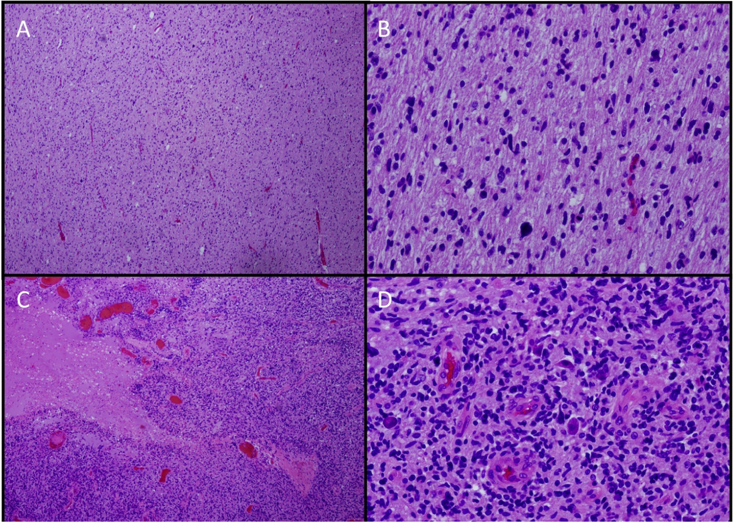 Histologic geographic variability of DIPG. ×4 (A,C) and ×20 (B,D). Hematoxylin and eosin stains from different sections of a single tumor showing low-grade (A,B) and high-grade (C,D) areas. Histologic geographic variability of DIPG. ×4 (A,C) and ×20 (B,D). Hematoxylin and eosin stains from different sections of a single tumor showing low-grade (A,B) and high-grade (C,D) areas.